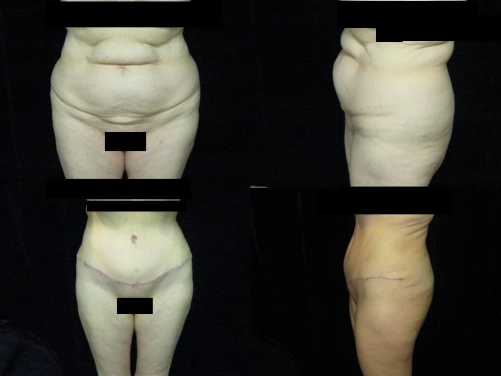 Mini Tummy Tuck by DFW Aesthetics and Cosmetic Surgery