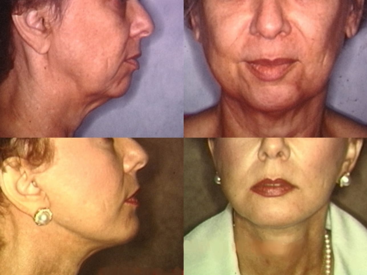 An old woman with face lift surgery