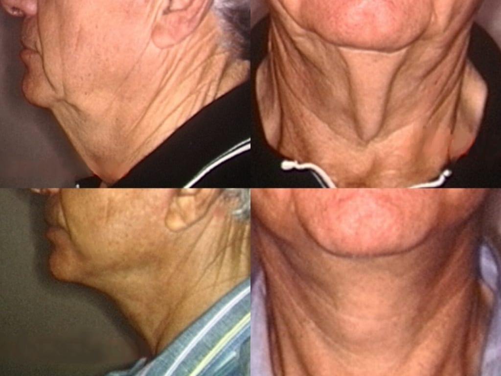 An old man a face lift surgery