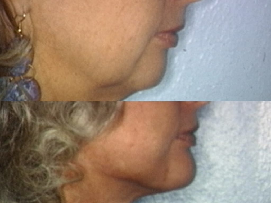 An old woman with a face lift surgery